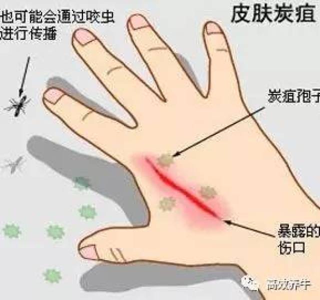 辽宁炭疽病疫情/辽宁炭疽病疫情严重吗