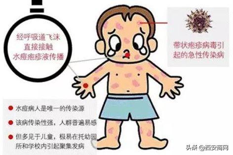 【水痘疫情处置规范/水痘疫情处置措施】